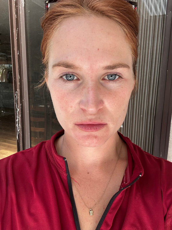 After Clear Skin Club