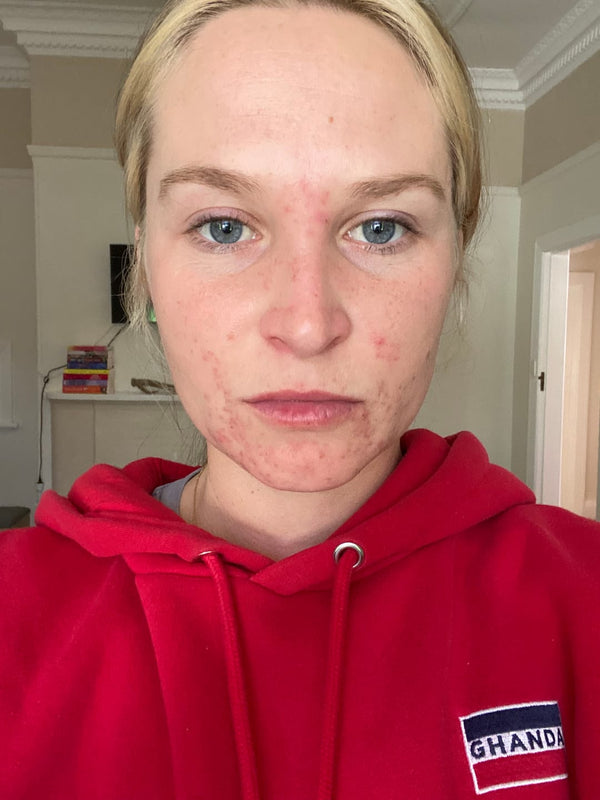 Before Clear Skin Club