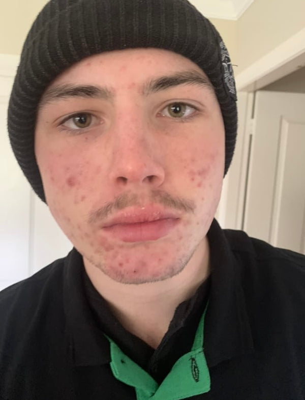 Before Clear Skin Club